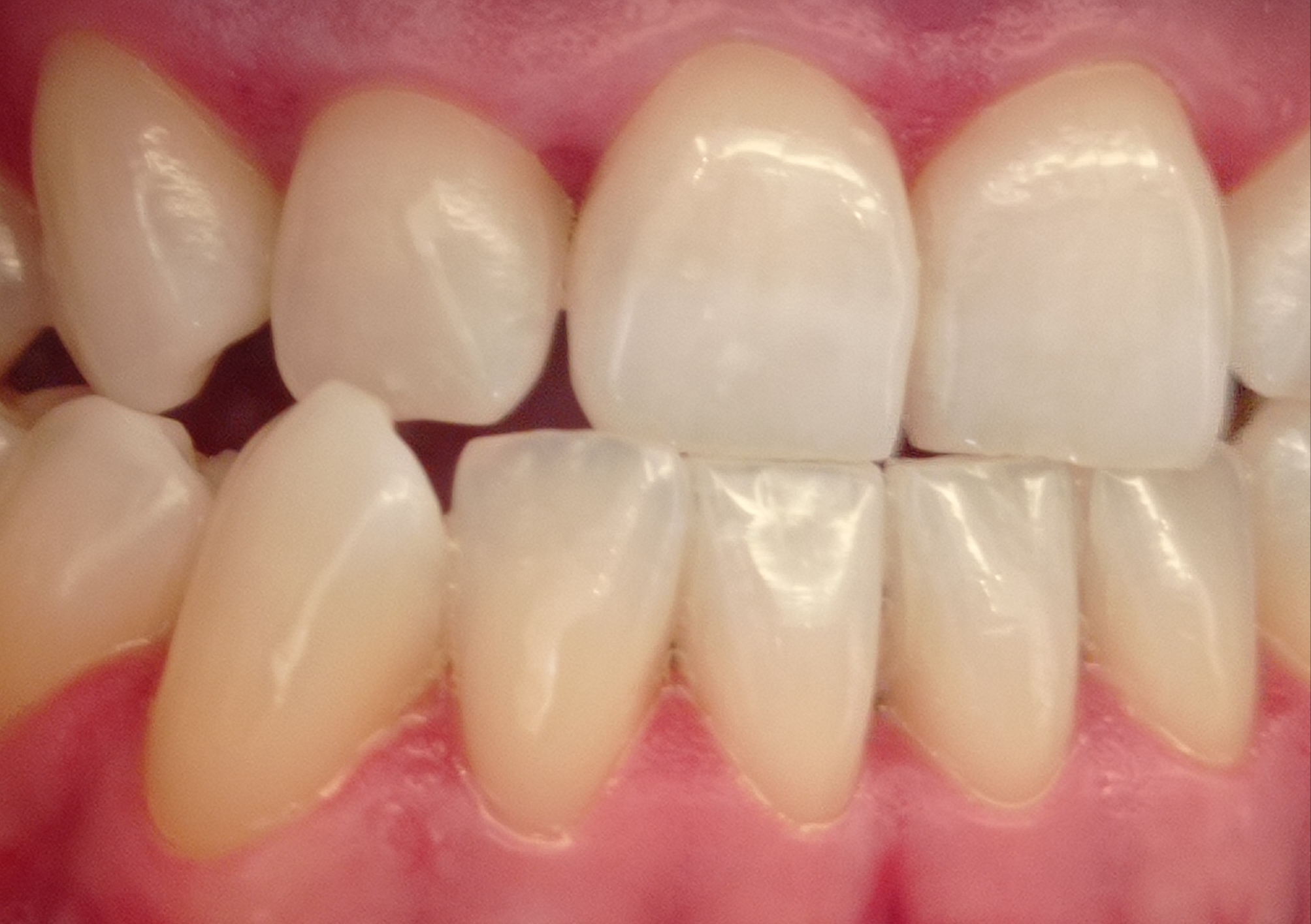 cover Λεύκανση