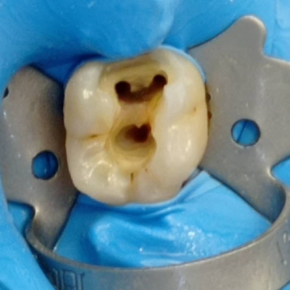 cover Ενδοδοντική Θεραπεία