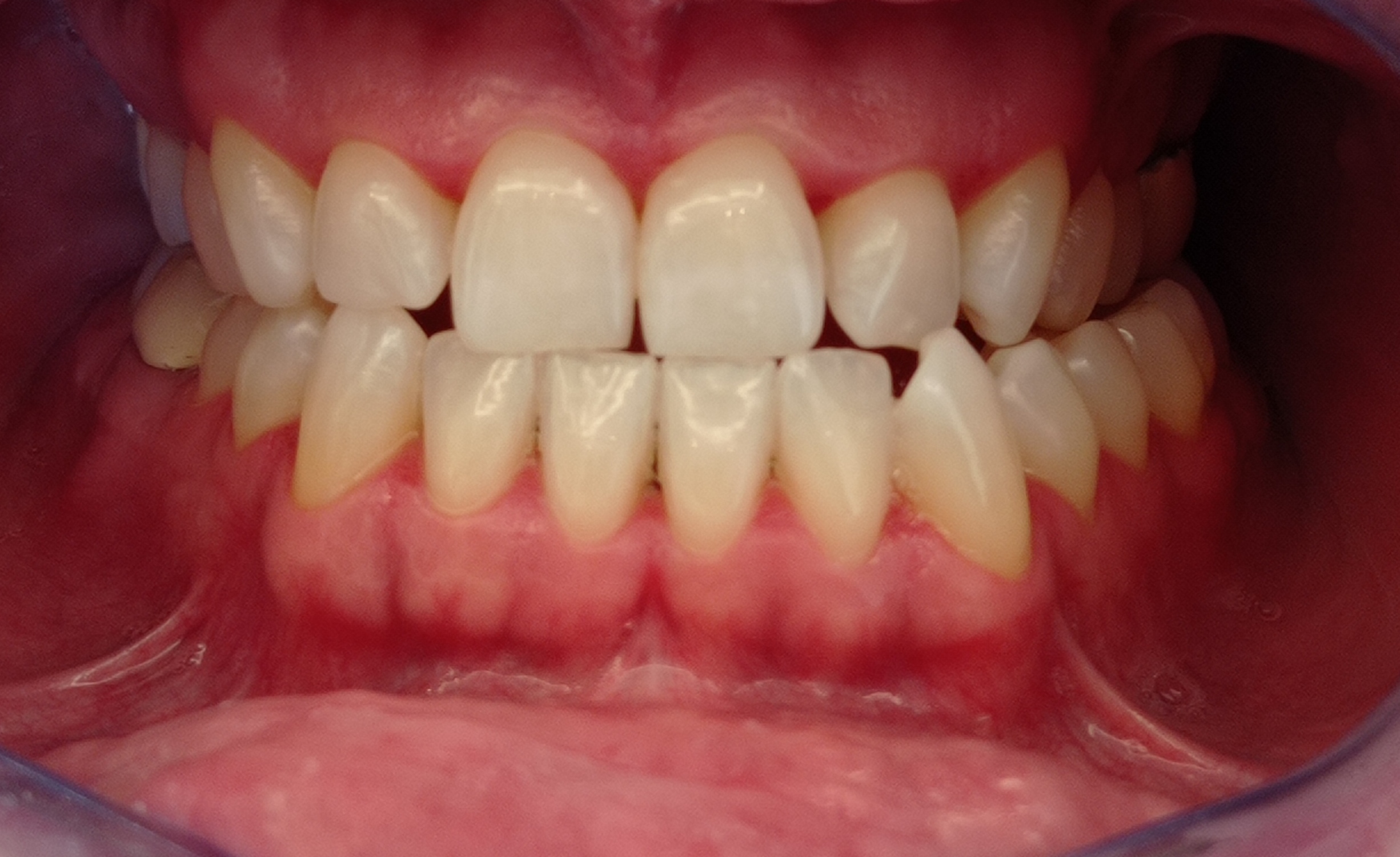 cover Λεύκανση